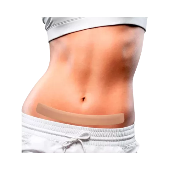 Fita Silicone Cirurgias abdômen inferior – NullScar® Abdômen M